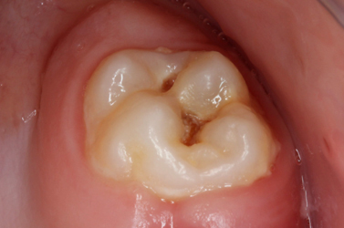 Zähne verfaulte Fehlende Zähne