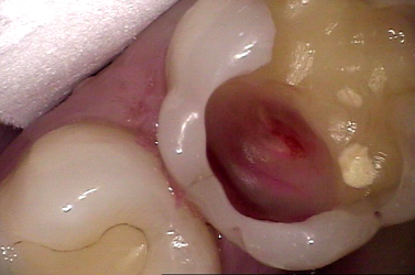 Zahnzement - Versiegeln Sie einen Zahn, der eine Füllung verloren hat  Gebrauchsfertiger Zahnzement zahnreparaturset - zahnfüllung Karies. :  : Drogerie & Körperpflege